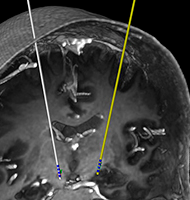 DBS electrodes visualised in neuroinspire neurosurgical planning software