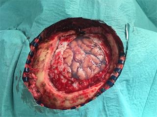 Damaged meninges, after craniotomy